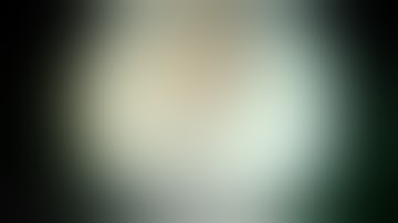 Arthroscopic anatomical transportal ACL reconstruction