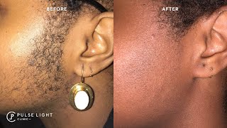 PCOS & Laser Hair Removal  - Excessive Hair Growth