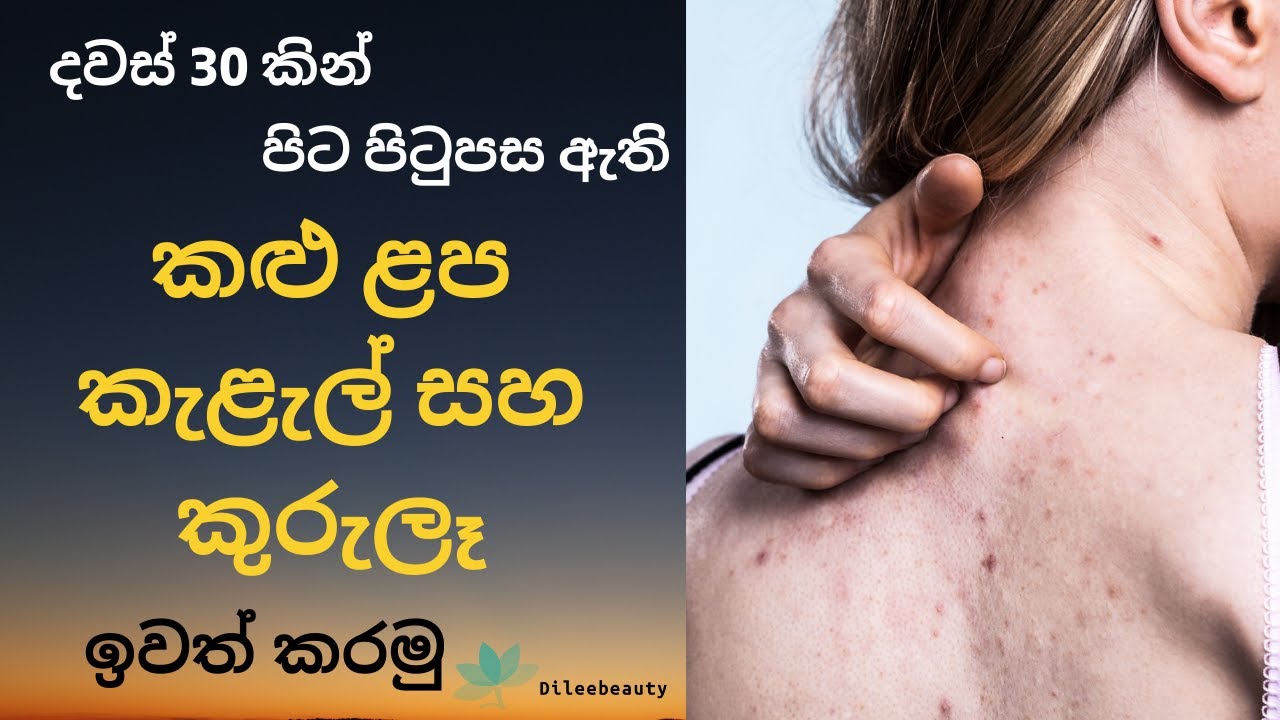 get-rid-of-back-acne-pimples-in-30-days-sinhala-with-dileebeauty