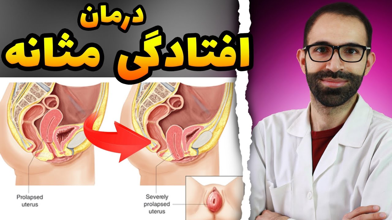 درمان افتادگی مثانه | علت افتادگی مثانه چیست | افتادگی مثانه در بارداری | درمان تکرر ادرار