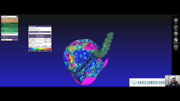 Aligning Meshes in Exocad