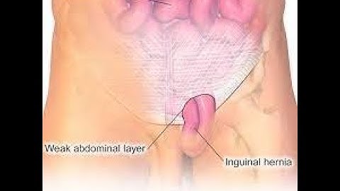 Repair Inguinal Hernia CPT code - simplify medical coding