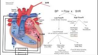 LVAD management