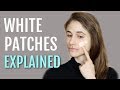 WHITE PATCHES ON THE FACE EXPLAINED (PITYRIASIS ALBA)| DR DRAY