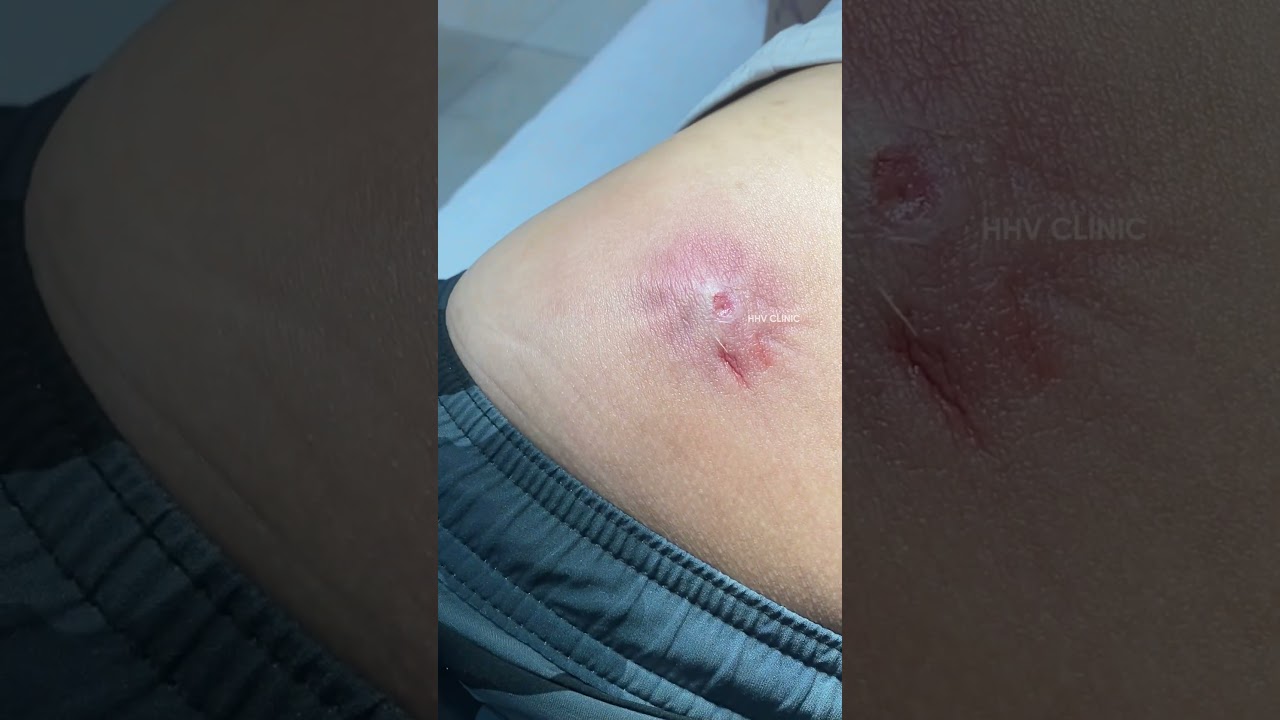 Nặn mụn nhọt ở mông