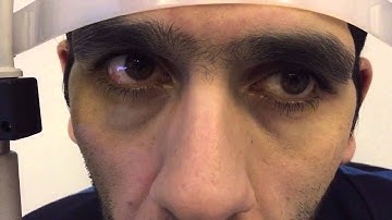 Macrosaccadic oscillations