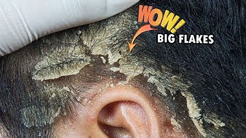 Itchy Dry Scalp Scratching Dandruff on Left Side #704