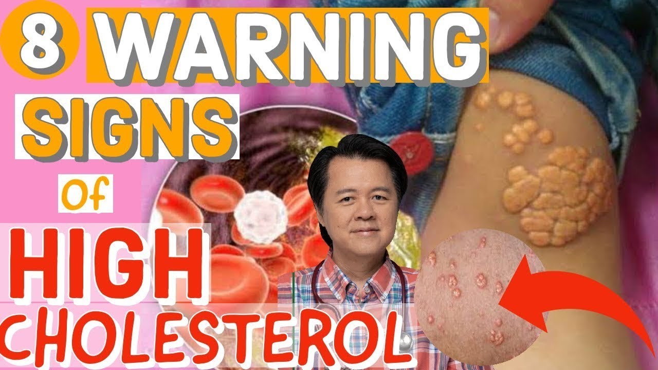 8 Warning Signs of High Cholesterol Payo ni Doc Willie Ong YouTube