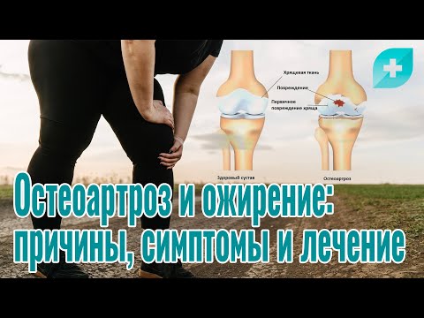 Остеоартроз и ожирение: причины, симптомы и лечение