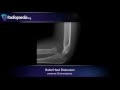 Radial head dislocation - radiology video tutorial (x-ray)
