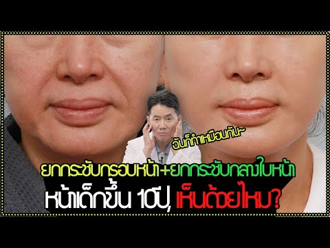 ยกกระชับกรอบหน้า + ยกกระชับกลางใบหน้า หน้าเด็กขึ้น 10ปี ?✨