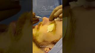 MicroRhinoplasty, Quick Procedure Under Local Anesthesia, To Remove Nose Bump screenshot 2