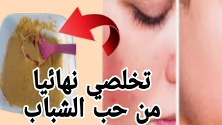 طريقة التخلص من حب الشباب وجميع انواع الحبوب بأسرع وصفة