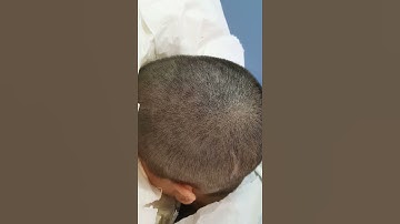 SMP Scalp & Scar Micropigmentation by El Truchan @ Scalp Micro Definition London