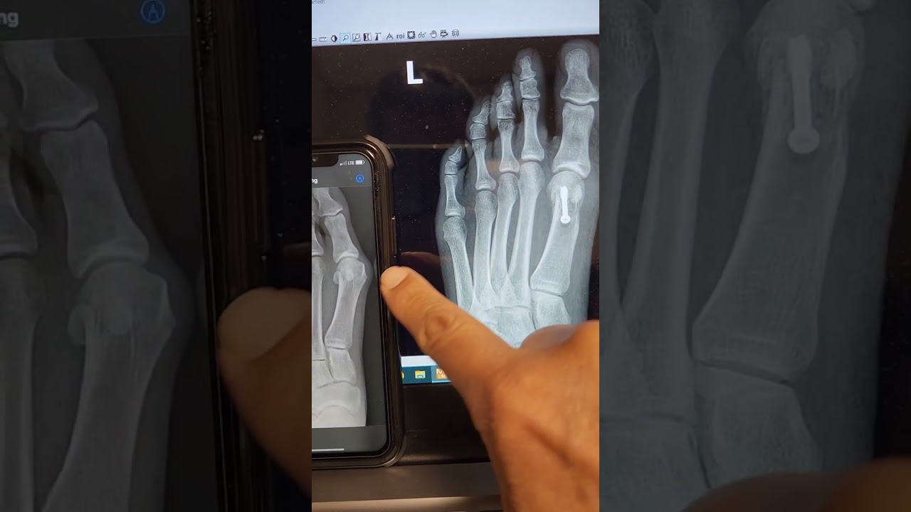 12 days after bunion surgery... still NO PAIN!!!