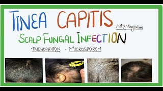 Tinea Capitis |fungal infection of scalp| causes, transmission, clinical features and Treatment