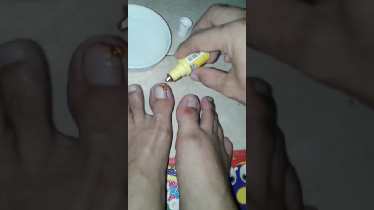 Cara Mengobati Nanah Di Kaki Cara mengobati termumulan pada jempol kaki - YouTube