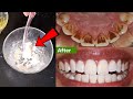 تبييض الاسنان في ثواني تزيل الاصفرار وتسقط الجير بعد فرك اسنانك بها والنتائج مدهشة !