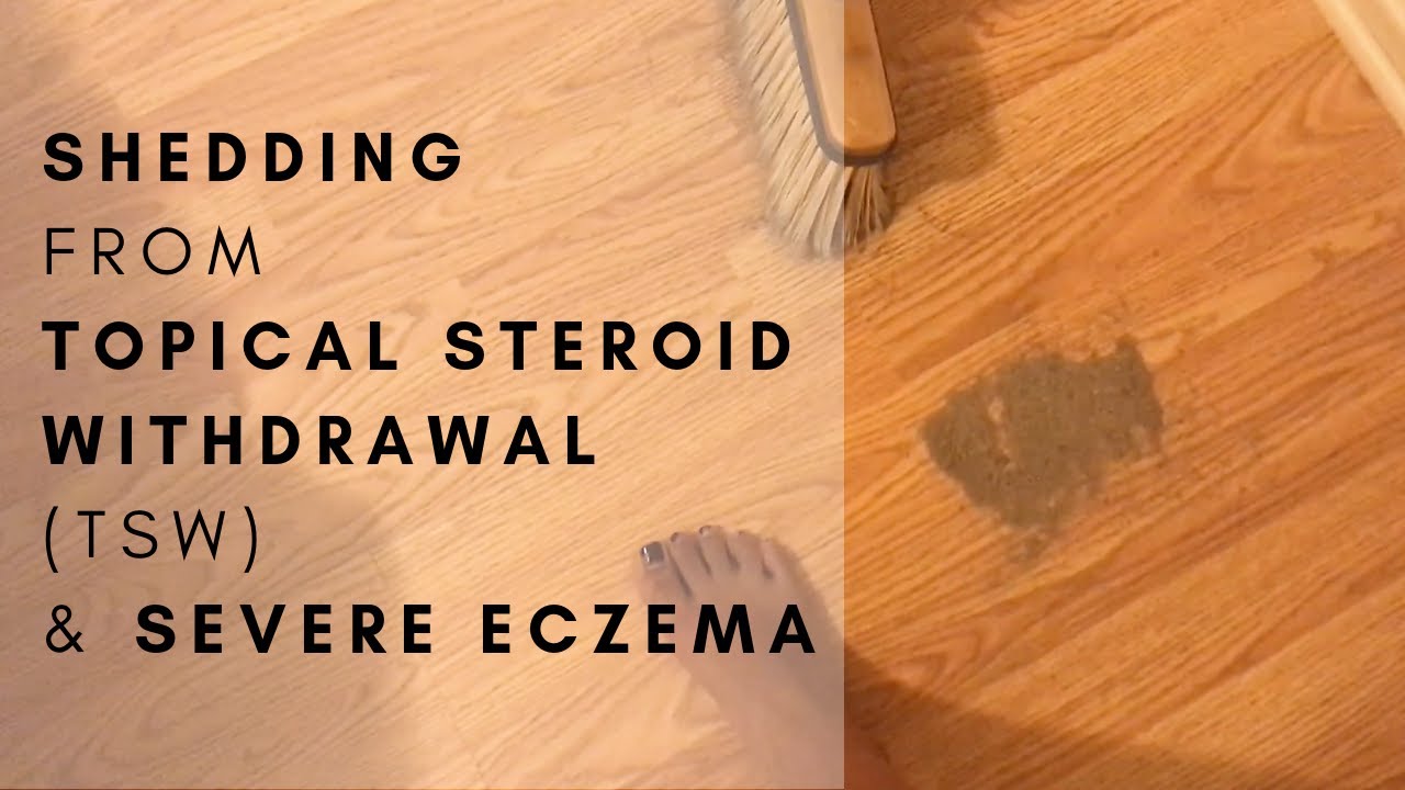 Healing Topical Steroid Withdrawal (TSW) & Severe Eczema | The Nat ...