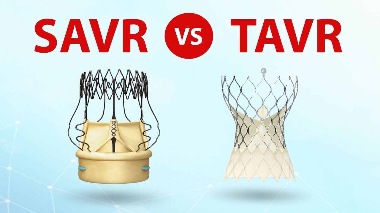 SAVR vs  TAVR Patient Webinar What Should Patients Know