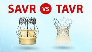 SAVR vs.  TAVR Patient Webinar: What Should Patients Know? screenshot 4