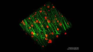 3D volume imaging - ALZHEIMER'S DISEASE MOVIE 1