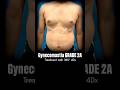 Tired of Hiding Your Chest? | Grade 2A Gynecomastia Transformation