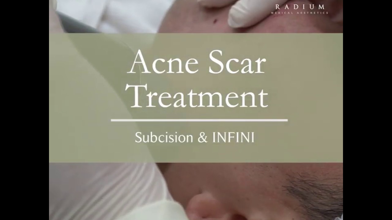 Acne Scar Removal Treatment Subcision & INFINI YouTube