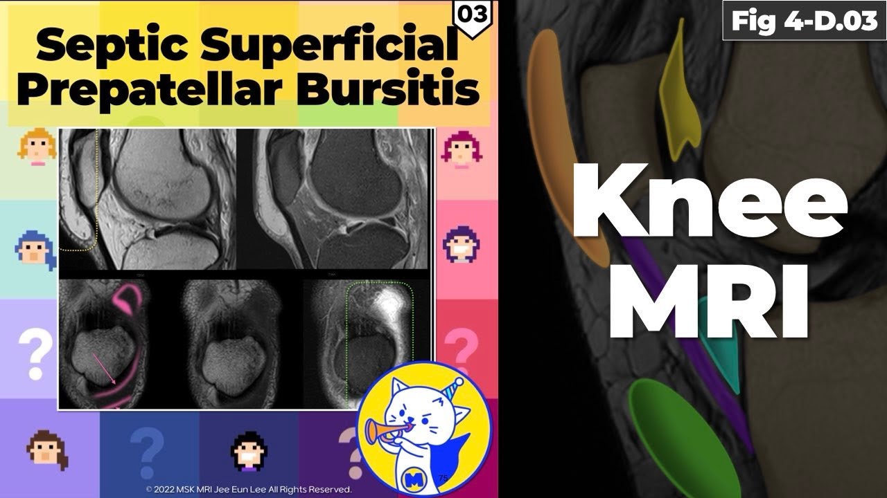 (Fig 4D.03) Septic Superficial Prepatellar Bursitis YouTube