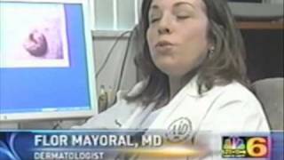 Merkel Cell Carcinoma NBC6 4-11-07 - Flor A. Mayoral MD.wmv