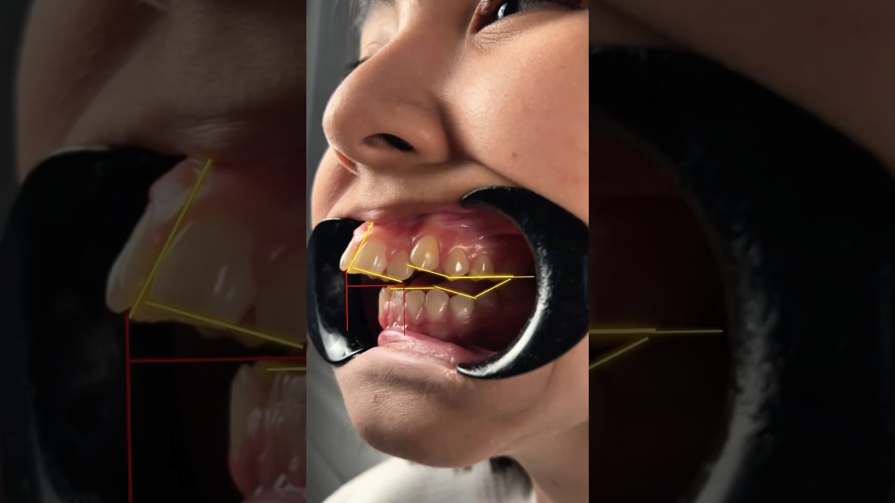 Open bite combined with a distal bite #dentalphotography #dentist #orthodontist #orthodontics