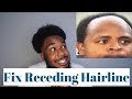 Fix your Receding Hairline