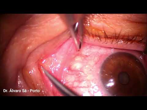 Exérese de Cisto Conjuntival - Dr Álvaro Sá