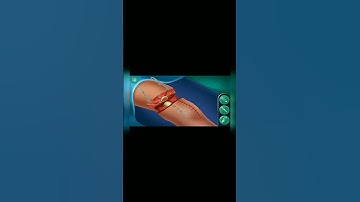 #Leg Amputation Surgery #shorts