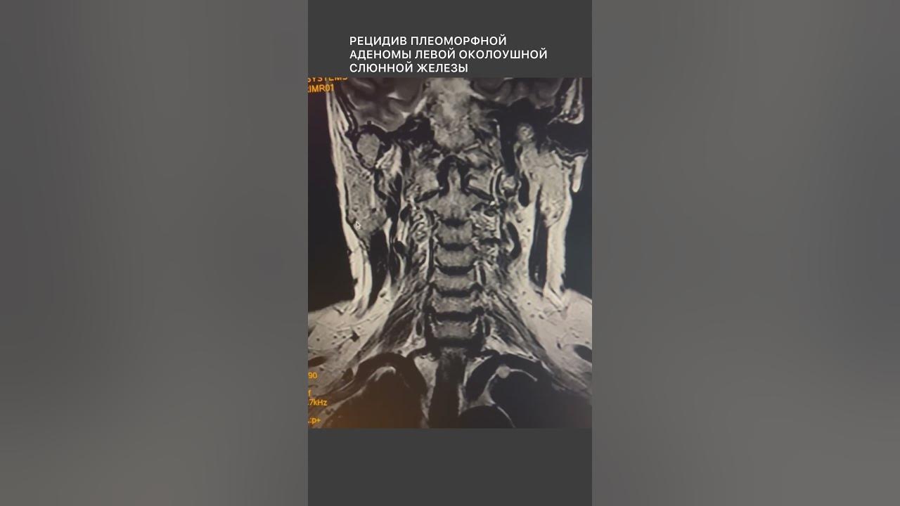 аденома бронха эндофото. лекарство при онкологии простаты. аденома рецидив. лазерная аденома простаты в чите. показания к хирургическому лечению узлового зоба.