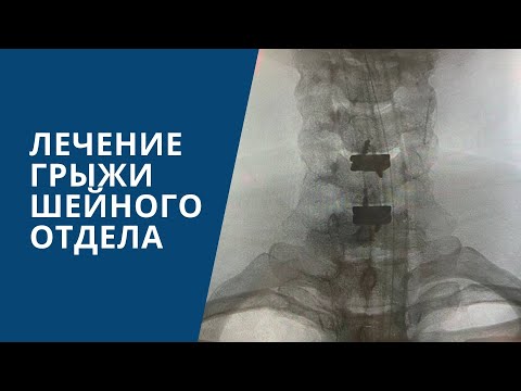 Удаление грыжи диска шейного отдела позвоночника C5-C6