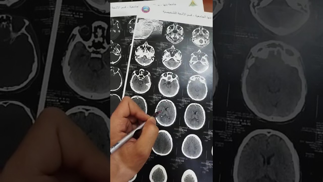 CT brain normal anatomy 