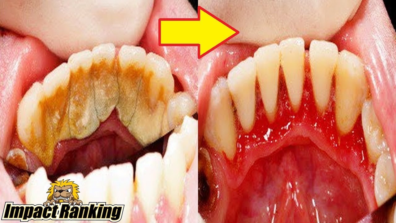歯 の 裏 歯石 取れ た