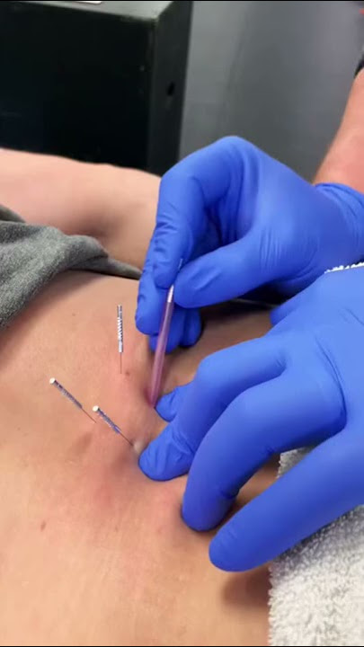 Low Back Dry Needling