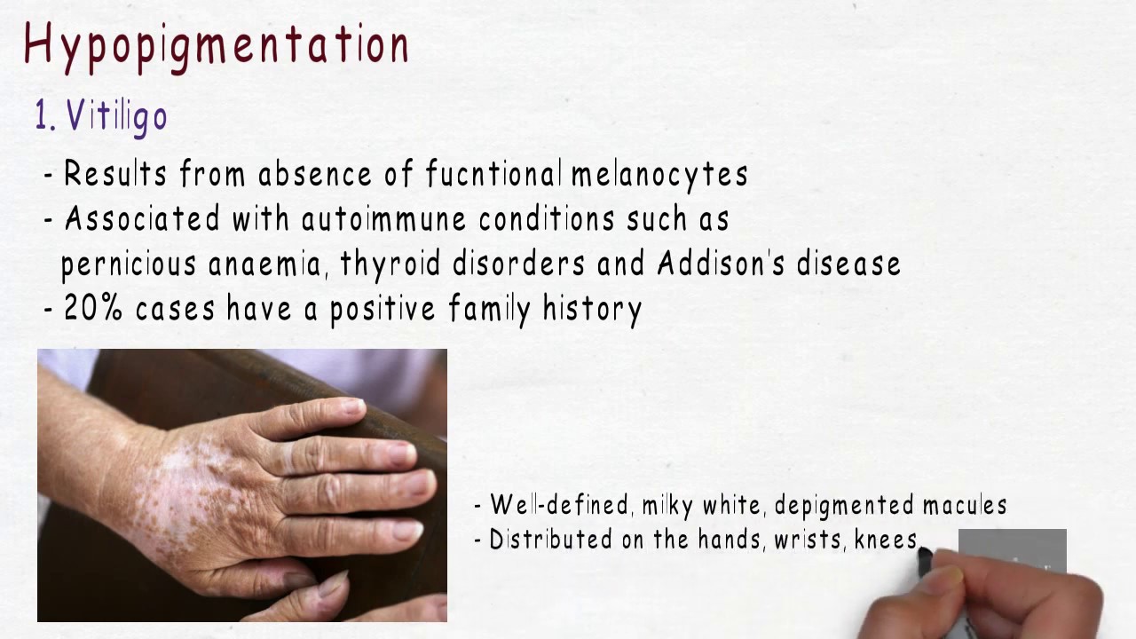 Rapid Review of Disorders of Pigmentation I: MRCS/ USMLE & other exams