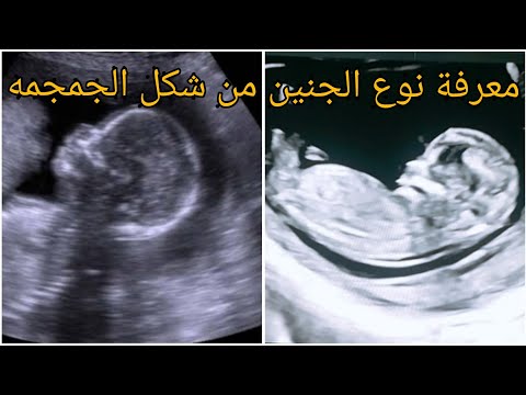 هل اتجاه راس الجنين يحدد نوعه؟