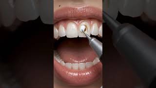 Cavity removal and perfect tooth filling #DentalCare #ToothFilling #CavityTreatment #SmileMakeover