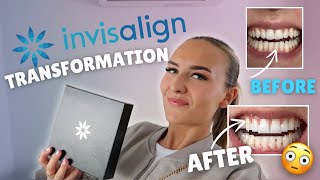 MY INVISALIGN JOURNEY🤍