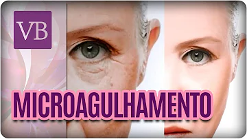 O que o Microagulhamento faz na pele?