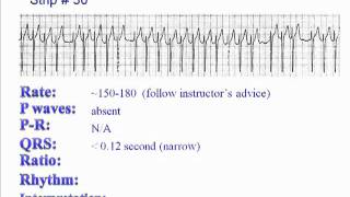 ECG: Exercise # 30