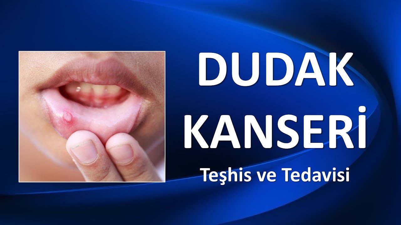 DUDAK KANSERİ Teşhis ve Tedavisi