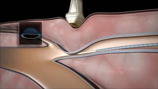 Periferica vascular es la que cirugia