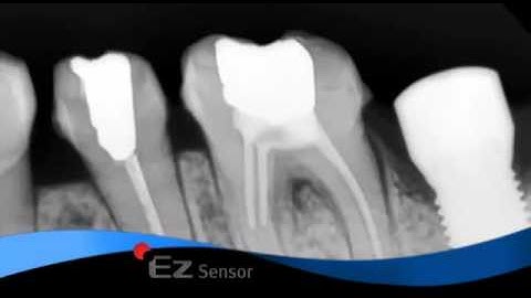 Vatech: EZ Sensor - Explanation Video