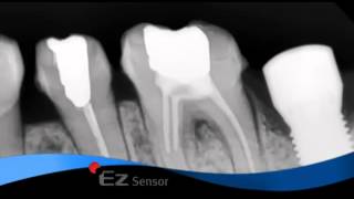 Vatech Ez Sensor - Explanation Video