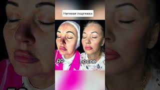 Альтернатива пластической операции - нитевая подтяжка. #миласбыковская #milasbykovskaya